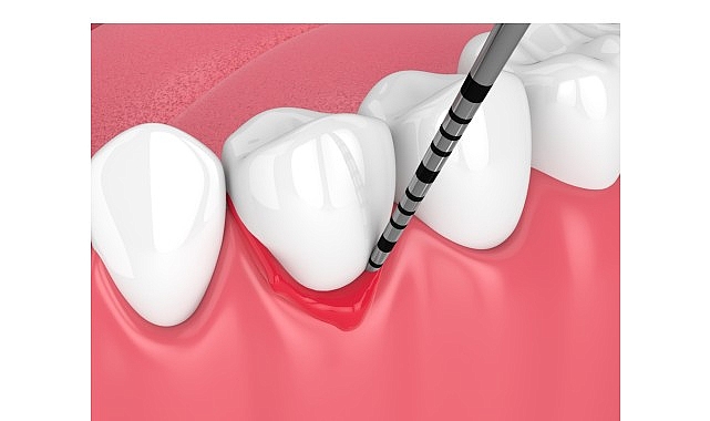 Diş Eti Kanaması: Gingivitis ve Periodontitis Uyarısı